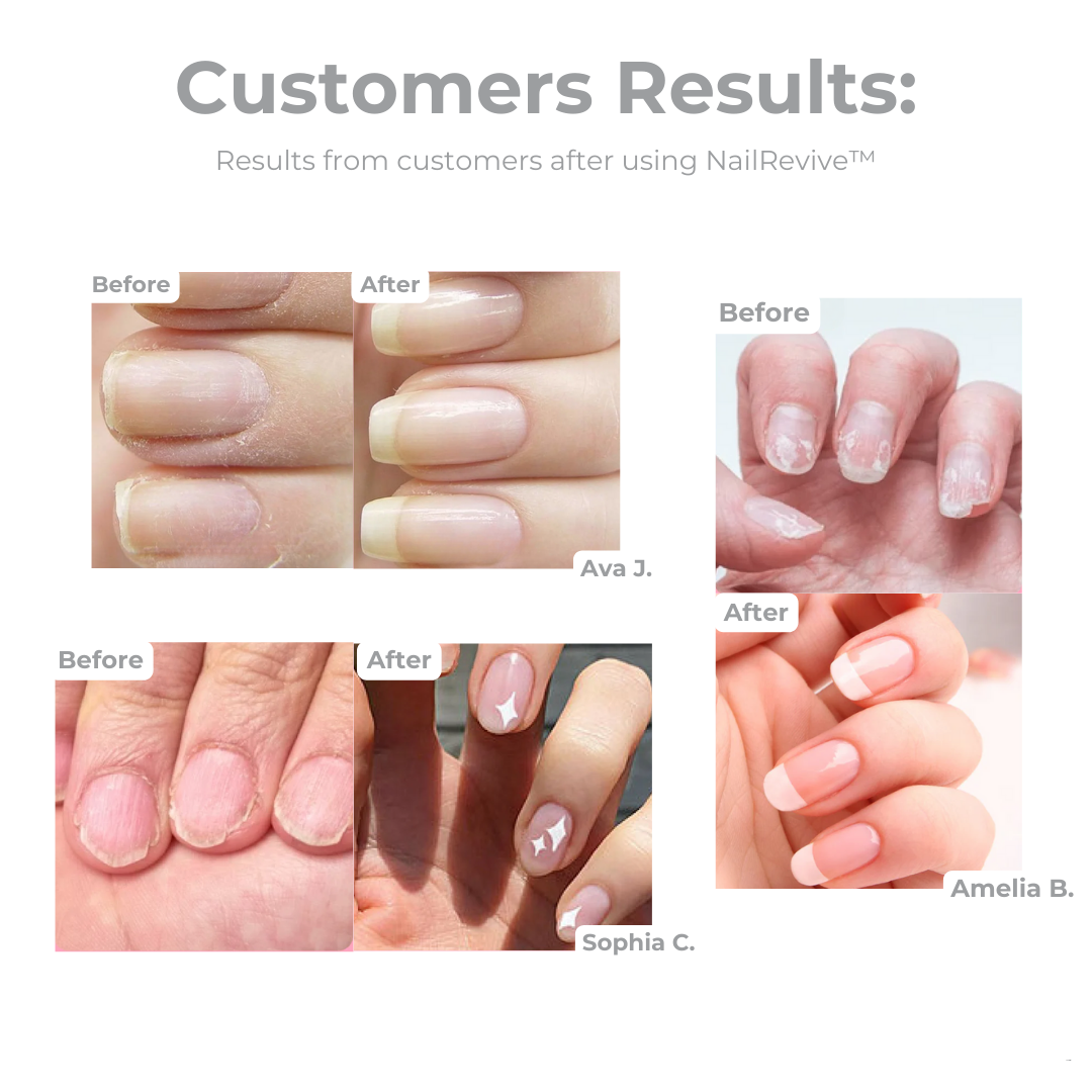 1+1 GRATIS | NailRevive™ | Nagelwachstumsöl