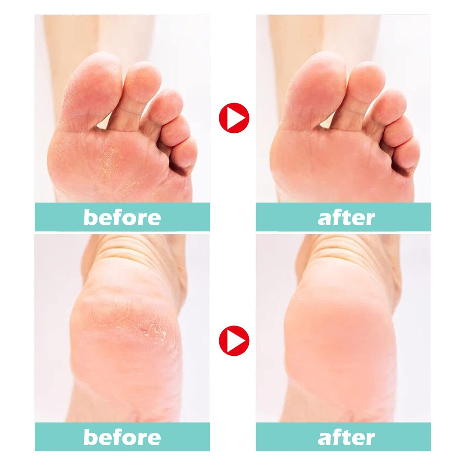 1+1 GRATIS | Medical Foot Care Cream™ | Heilt und schützt rissige Haut für langanhaltenden Komfort