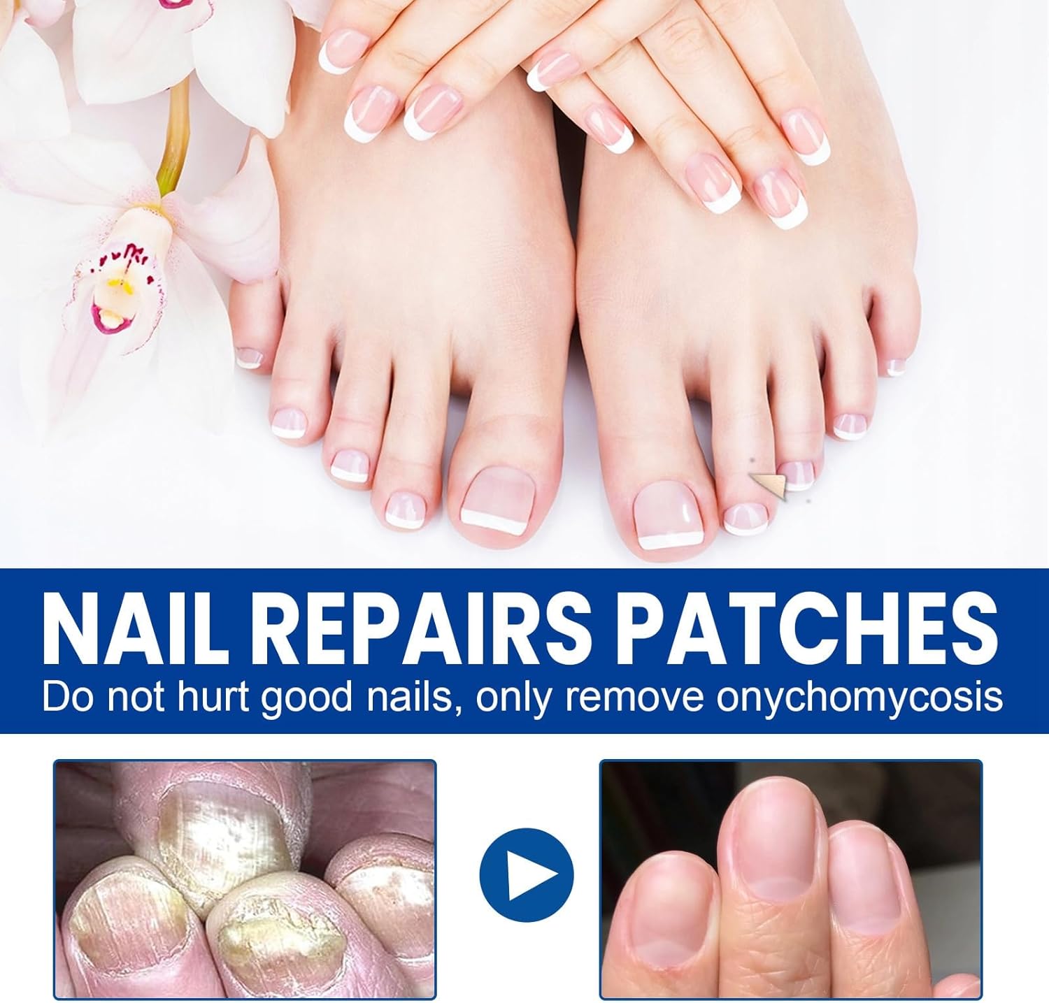 1+1 Gratis | Nailox™  | Wirksame Behandlung von Nagelpilz