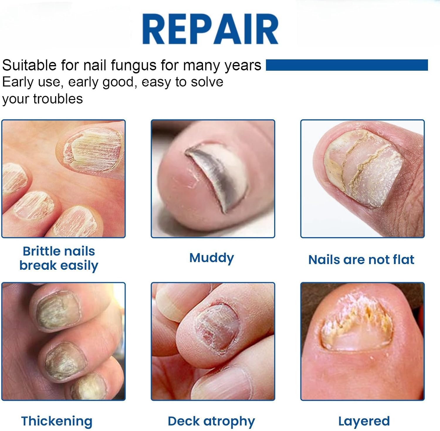 1+1 Gratis | Nailox™  | Wirksame Behandlung von Nagelpilz