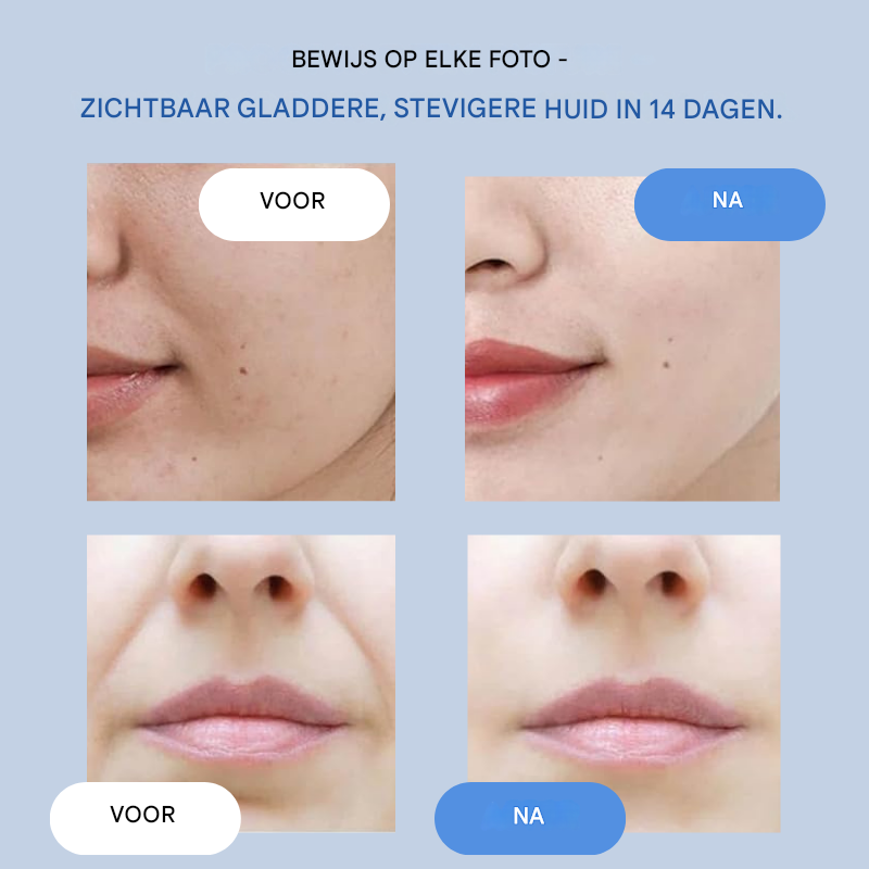 1+1 Gratis | LumièreLift™ | Premium Skin Strips – Glätten, straffen und revitalisieren Sie sofort das natürliche Aussehen Ihrer Haut.