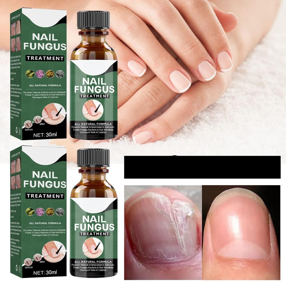 50 % Rabatt | NagelPilz™ | Heilt, restauriert & schützt beschädigte Nägel