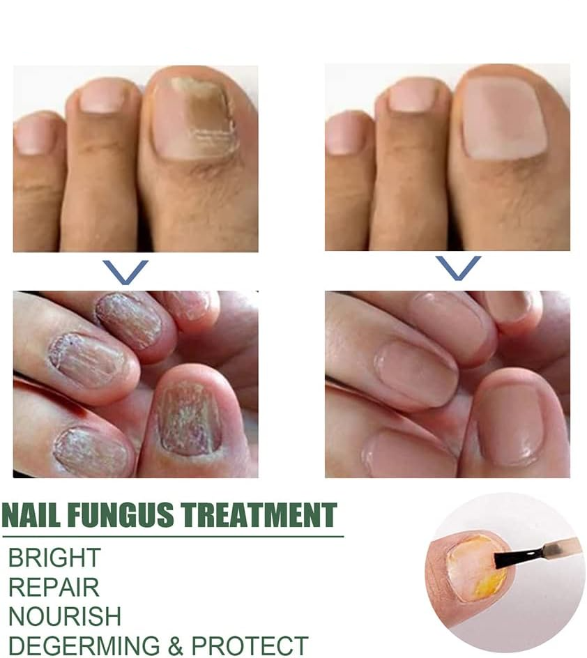 50 % Rabatt | NagelPilz™ | Heilt, restauriert & schützt beschädigte Nägel