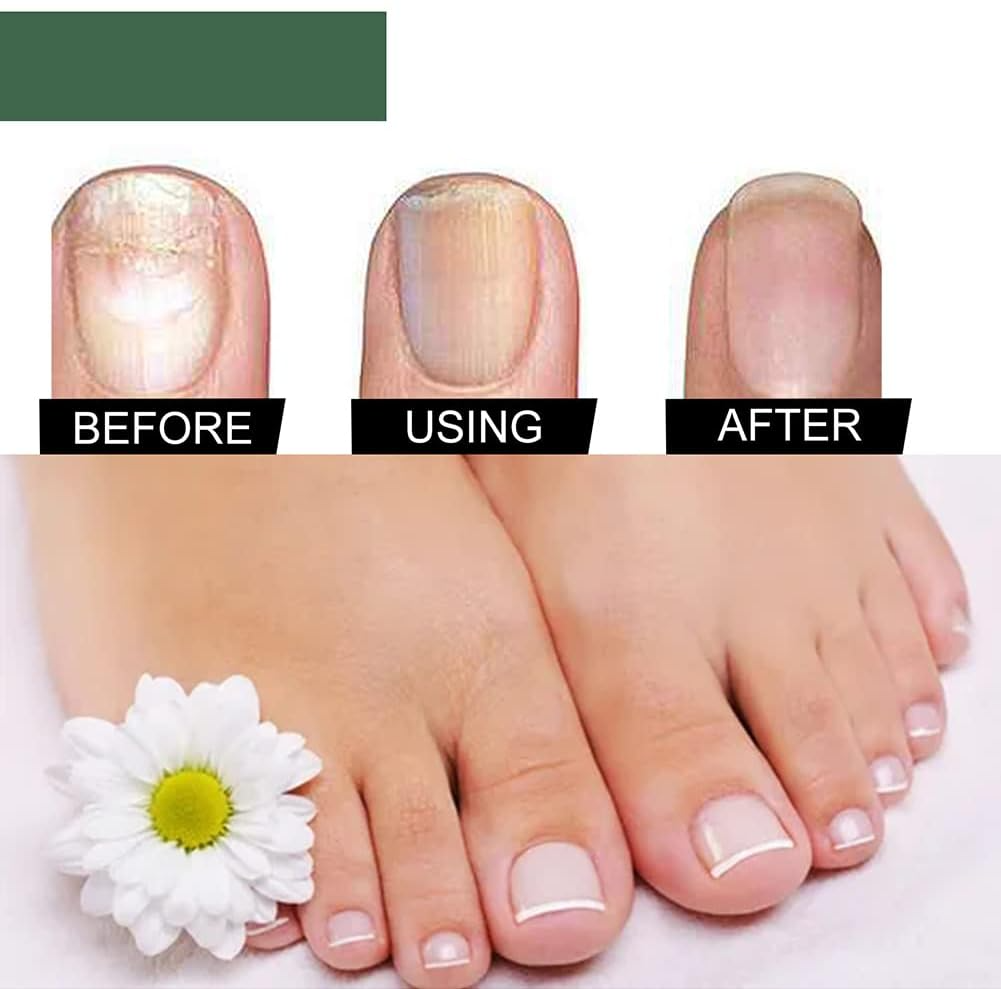 50 % Rabatt | NagelPilz™ | Heilt, restauriert & schützt beschädigte Nägel