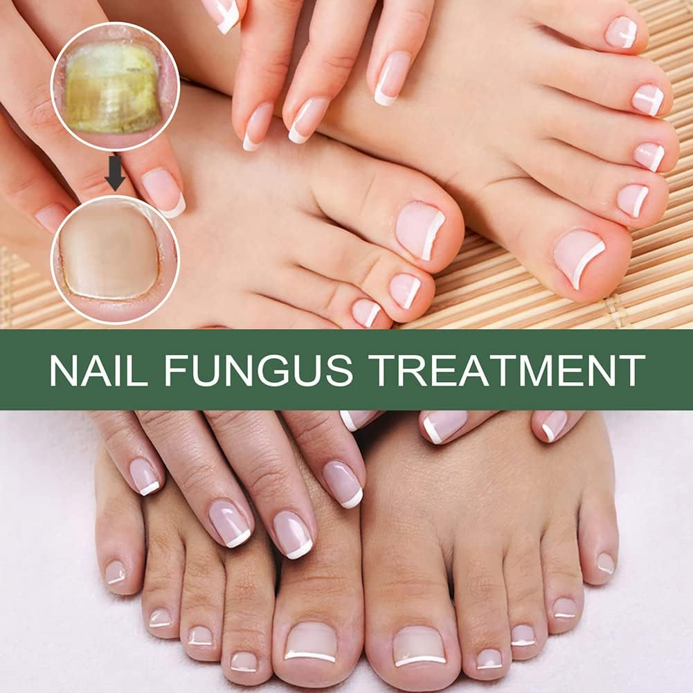 50 % Rabatt | NagelPilz™ | Heilt, restauriert & schützt beschädigte Nägel