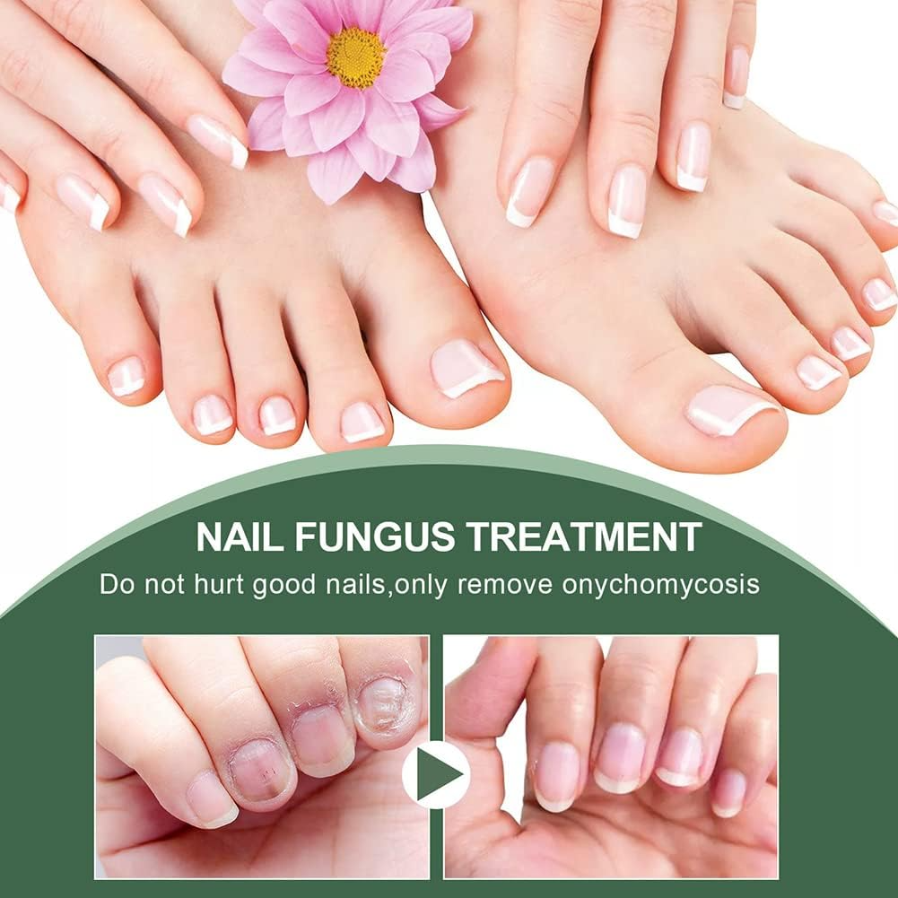 50 % Rabatt | NagelPilz™ | Heilt, restauriert & schützt beschädigte Nägel