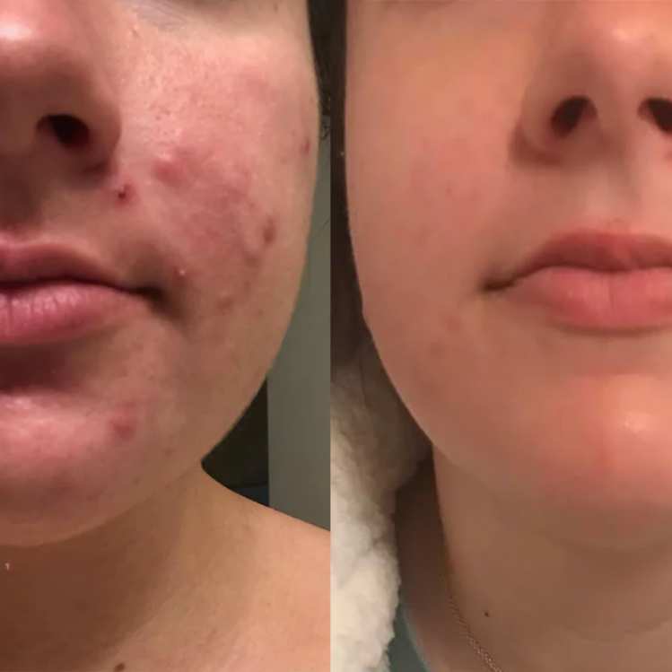 1+1 Gratis | Dermiva | Silikon-Narbentücher