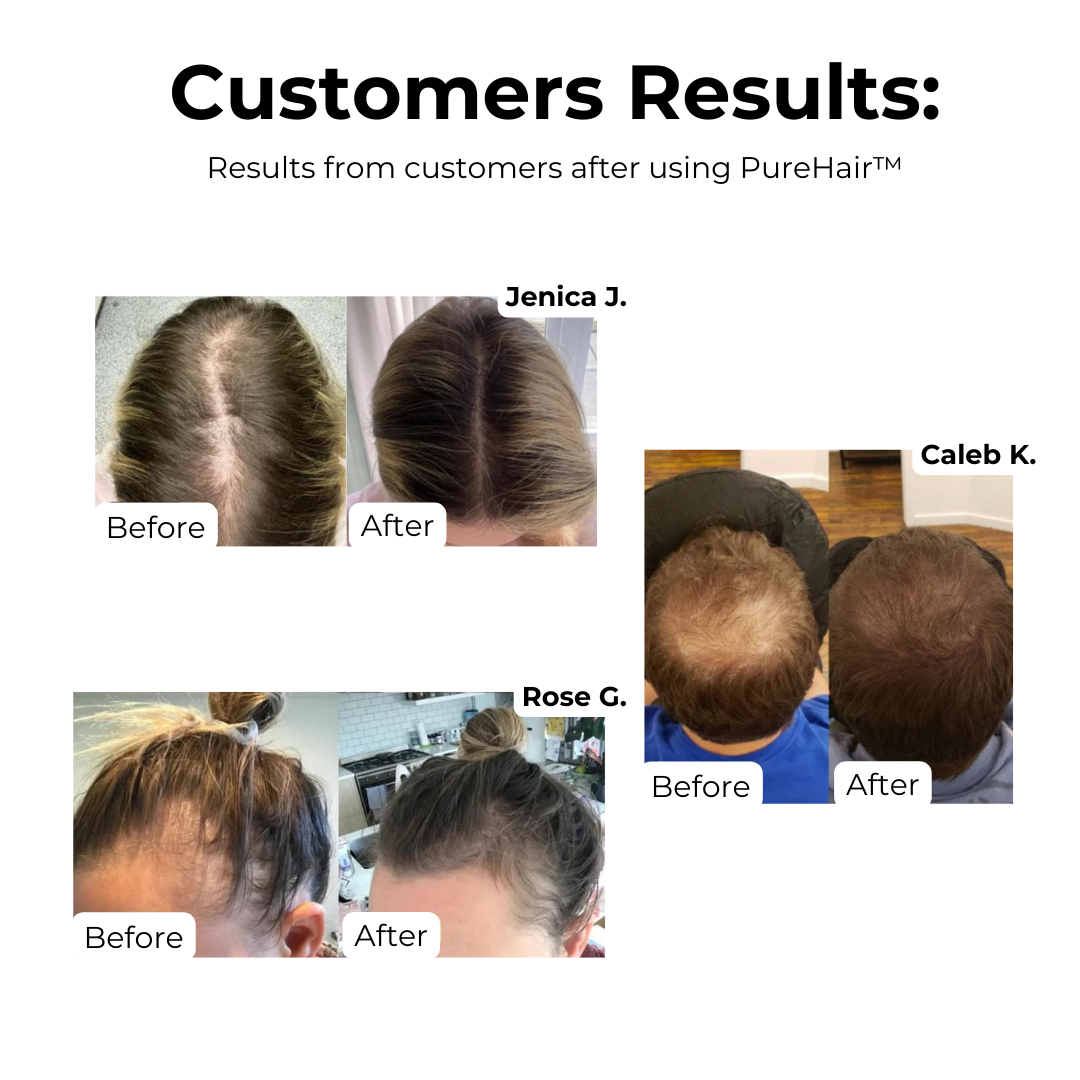 1+1 GRATIS | PureHair™ | Natürliches Haarwuchsöl