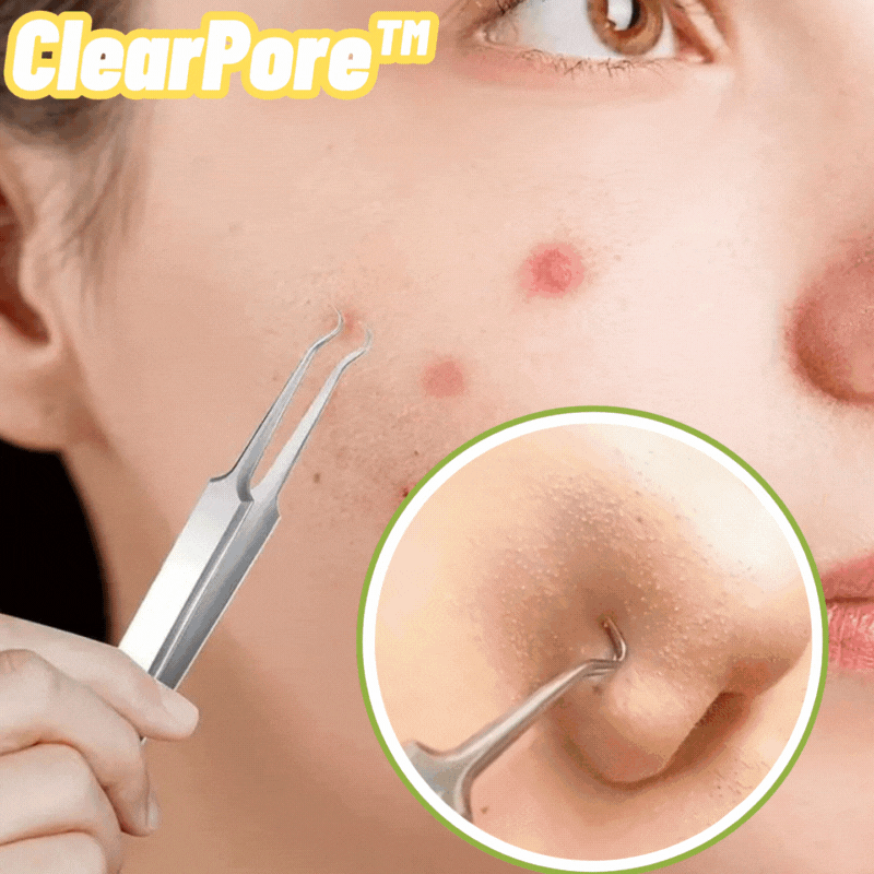 Movina Rostami 1+1 Gratis | ClearPore™ | Mitesser-Pinzetten-Entferner-Set, präzise, e ...